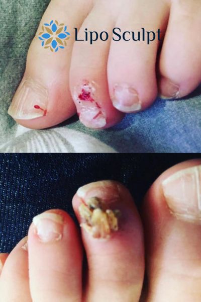 Wart removal customer results from Lipo Sculpt City of London